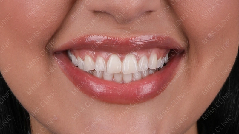 Hollywood smile results 